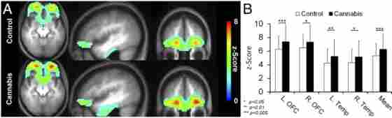 Cannabis users showed higher resting brain activity in the frontal and temporal areas compared with non-users.