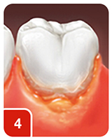 Severe Inflammation (marked redness, edema, and/or enlargement, spontaneous bleeding, or ulceration of the gingival unit)