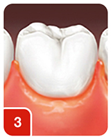 Moderate Inflammation (moderate glazing, redness, edema, and/or enlargement of the gingival unit)