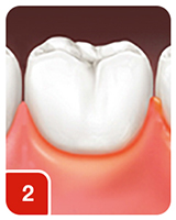 Mild Inflammation of the entire gingival unit