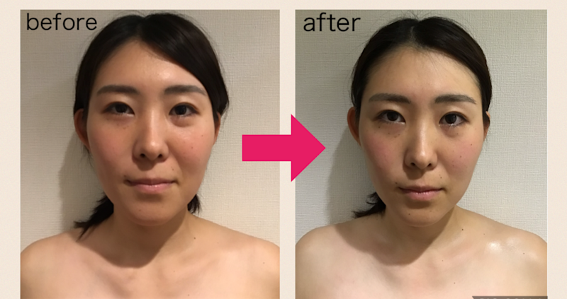 ハイパーフェイシャルBA2 HOTP・HP済 ハイパーフェイシャルBA2 HOTP・HP済