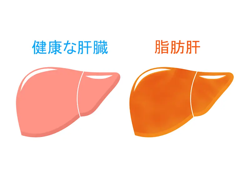 肝臓 脂肪肝 肝臓 脂肪肝