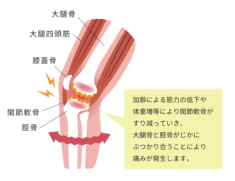 膝痛の仕組み イラスト