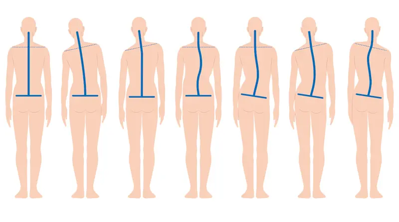 背骨の歪み イラスト 背骨の歪み イラスト