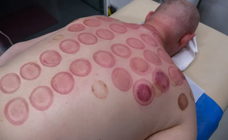 カッピング 男性 跡