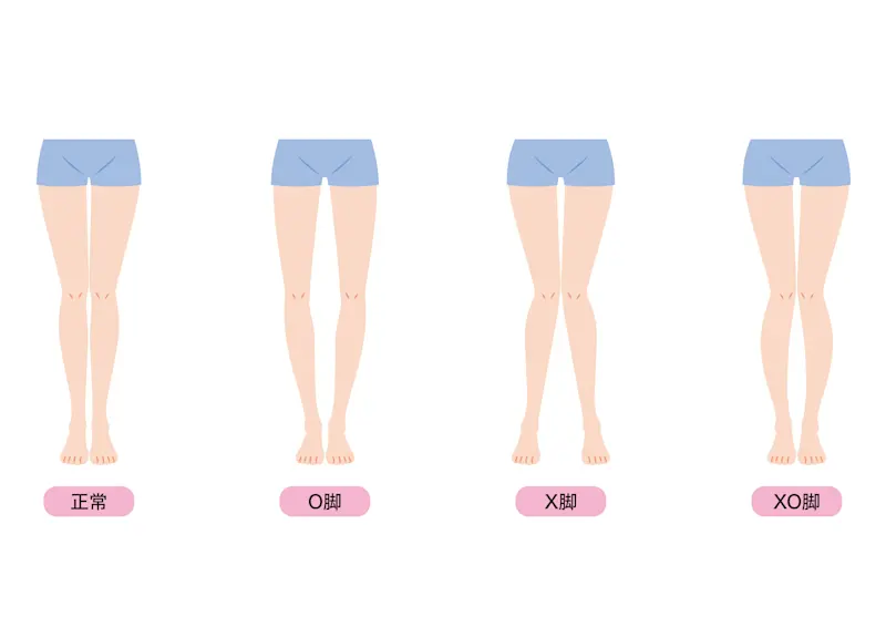 O脚・X脚 イラスト