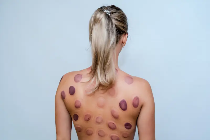 カッピング 跡