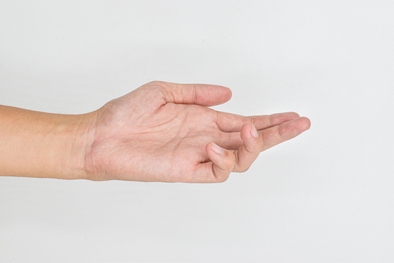 What is Dupuytren's contracture? Signs you have it and how to treat it