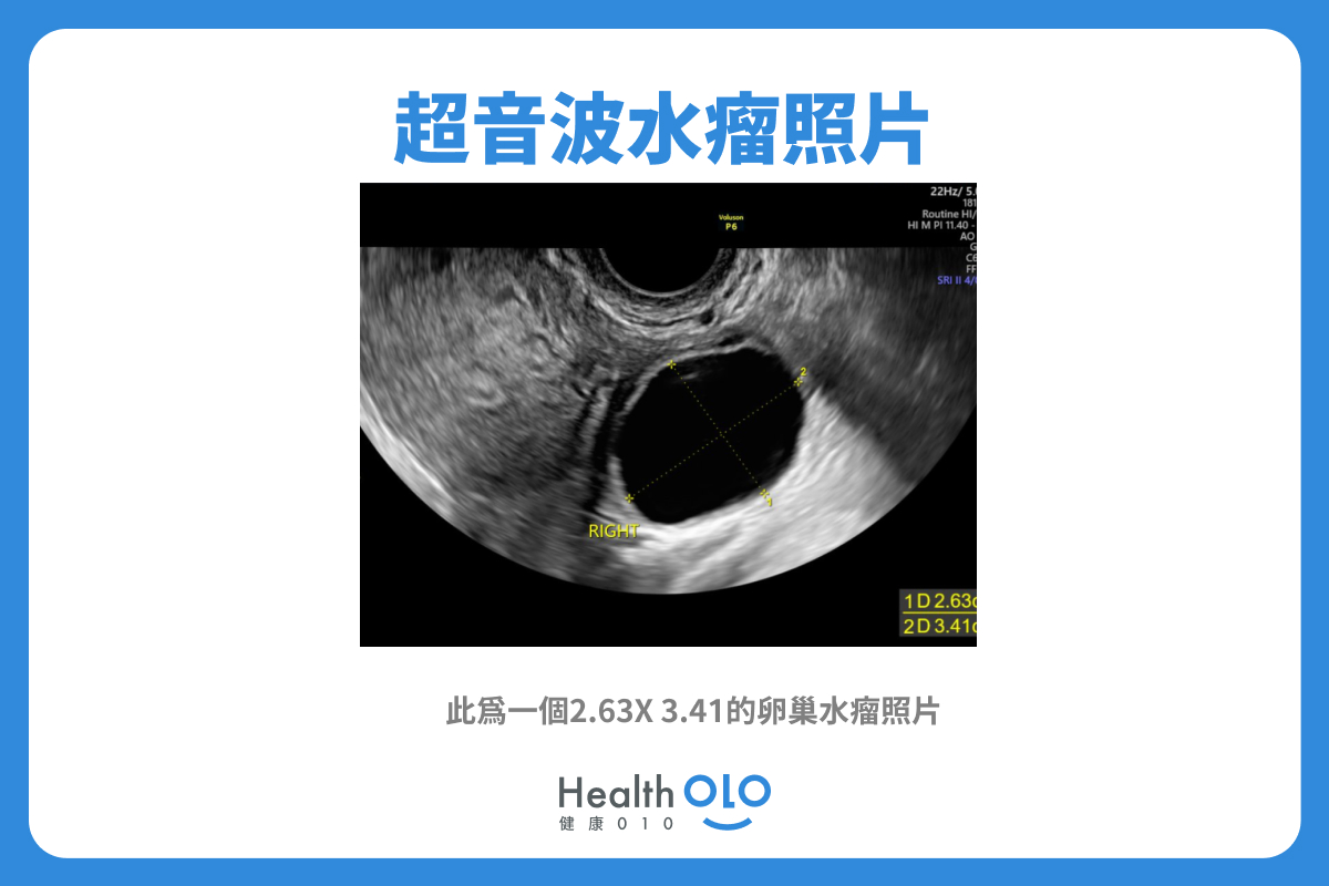 病例6-52 浆液性囊腺瘤(2)-临床医学-医学