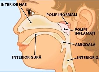 ✅️ Adenoidita cronică ✅️