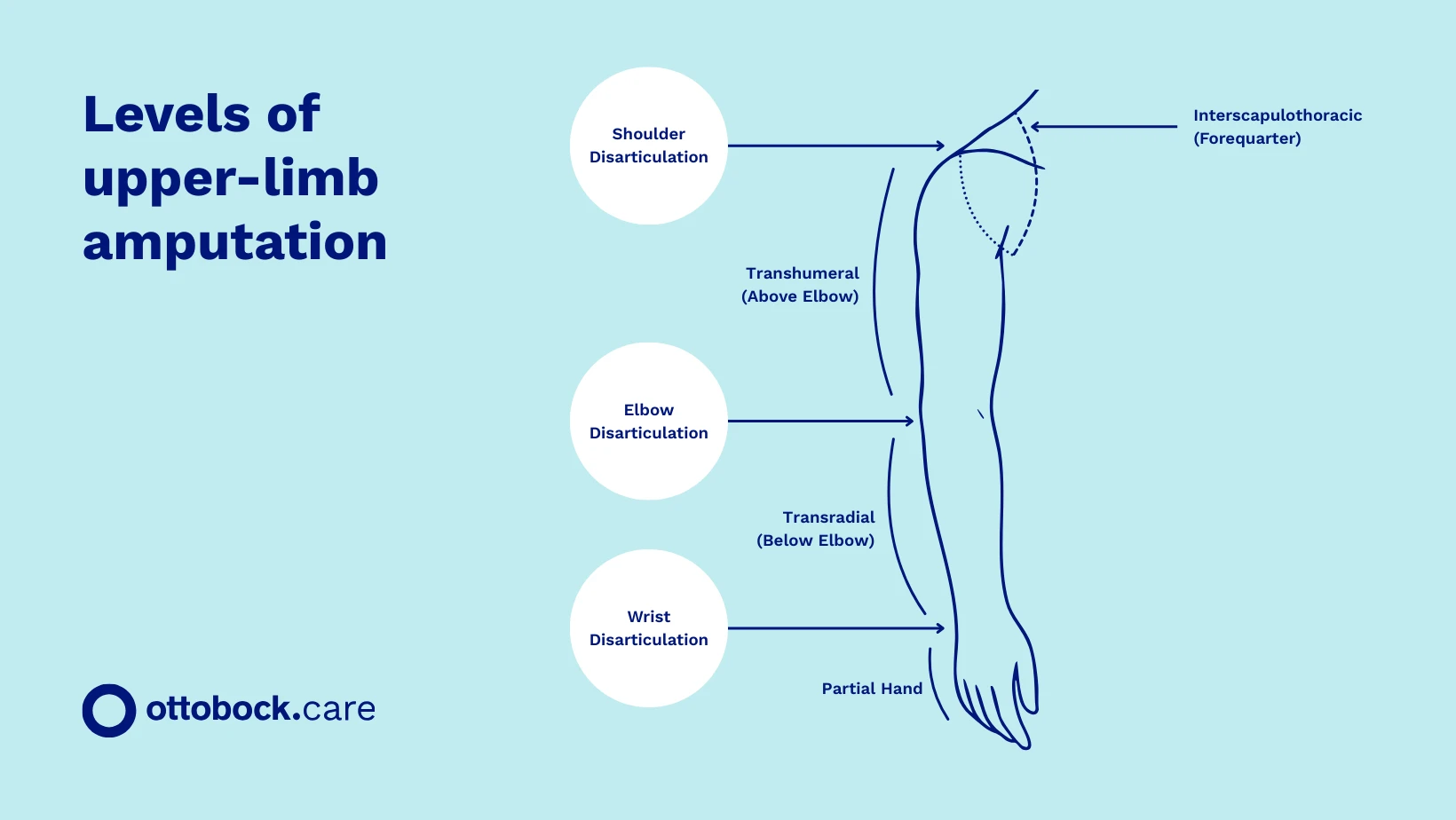 An illustration indicating the various levels of upper limb amputations