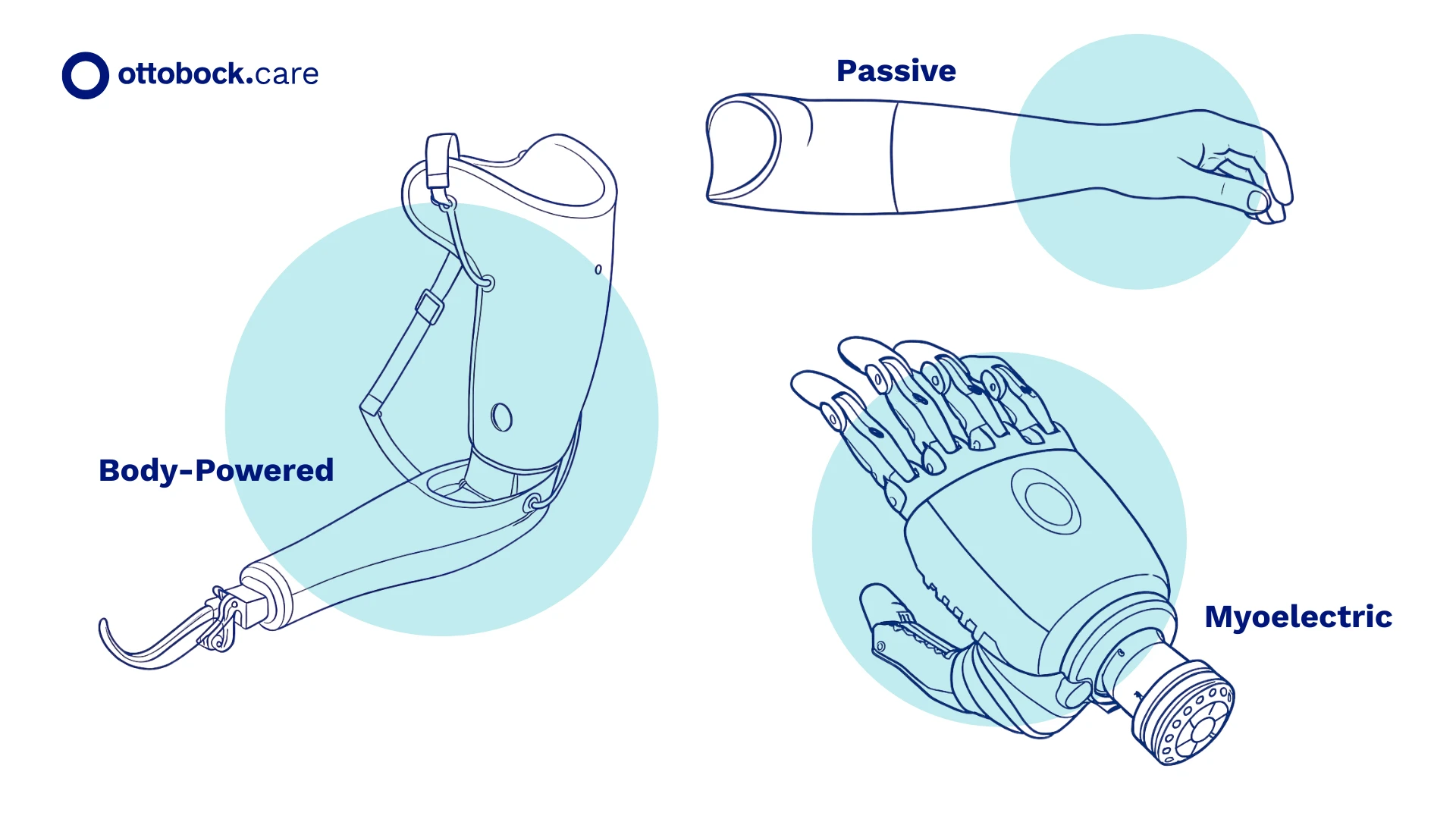 A graphic image showcasing the various product types of upper limb prosthetics, including body-powered, passive, and myoelectric