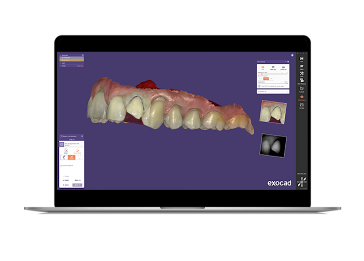 Intraoral scanners itero