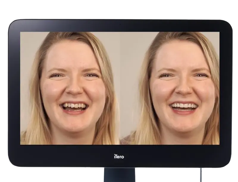 iTero