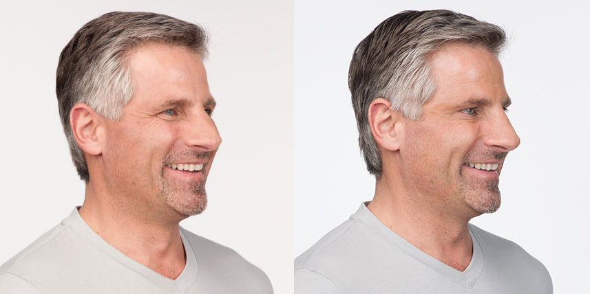 Efekty botoksu przed i po