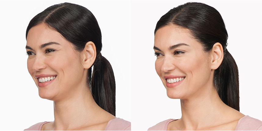 Efekty botoksu przed i po