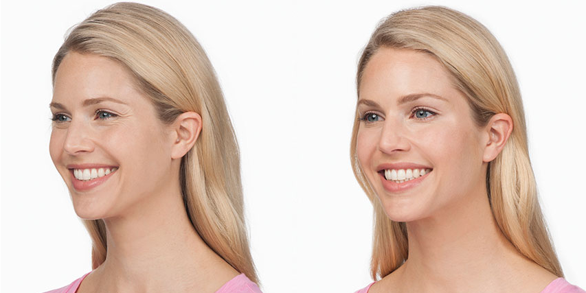 Efekty botoksu przed i po