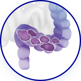 Каловый комок 1
