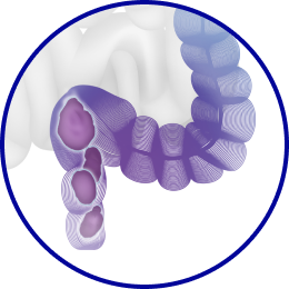 Нормализация стула