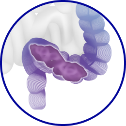 Каловая пробка