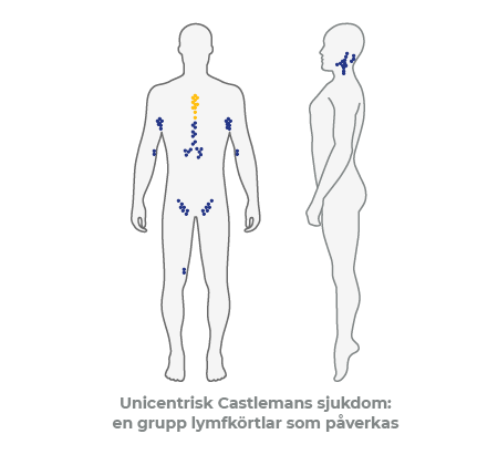 Castleman disease