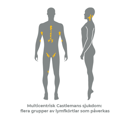 Multicentric Castleman disease