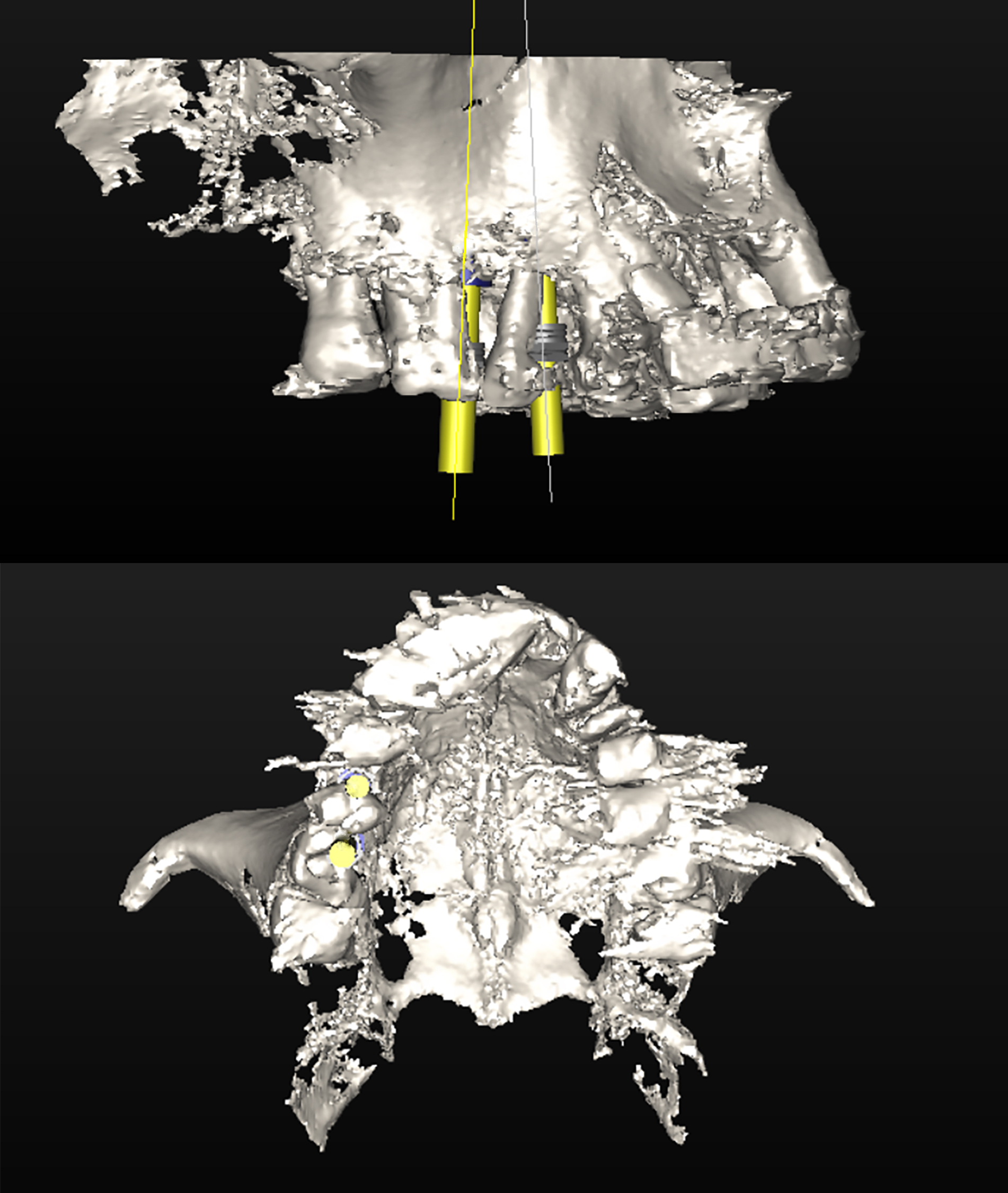 Δύο διαφορετικές απόψεις των ψηφιακώς τοποθετημένων εμφυτευμάτων στην τρισδιάσταση αναπαράσταση του οστού της άνω γνάθου
