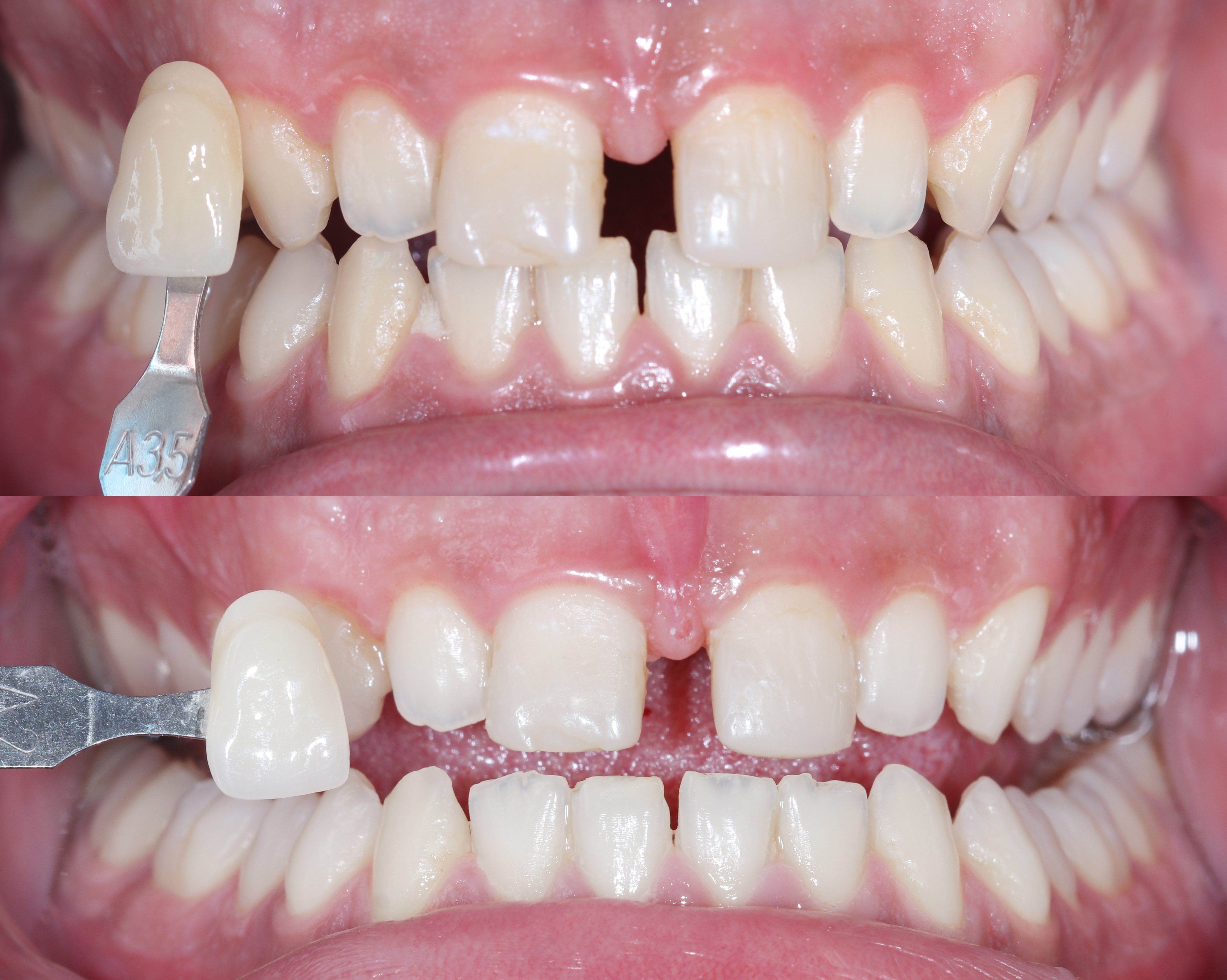 Το χρώμα των δοντιών πριν και μετά την λεύκανσή τους