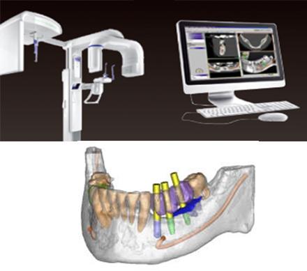 Η εξέταση CBCT επιτρέπει τρισδιάστατο σχεδιασμό εμφυτευμάτων με μεγαλύτερη ακρίβεια και ασφάλεια, βοηθώντας στην αξιολόγηση του οστού και σημαντικών ανατομικών δομών πριν την τοποθέτηση εμφυτευμάτων.