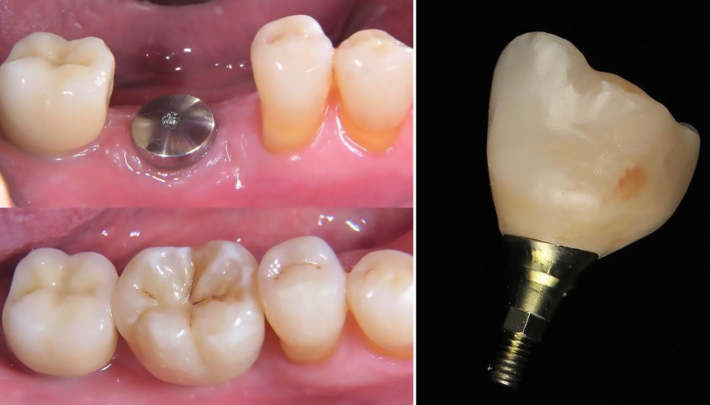 Single implant restoration (1)