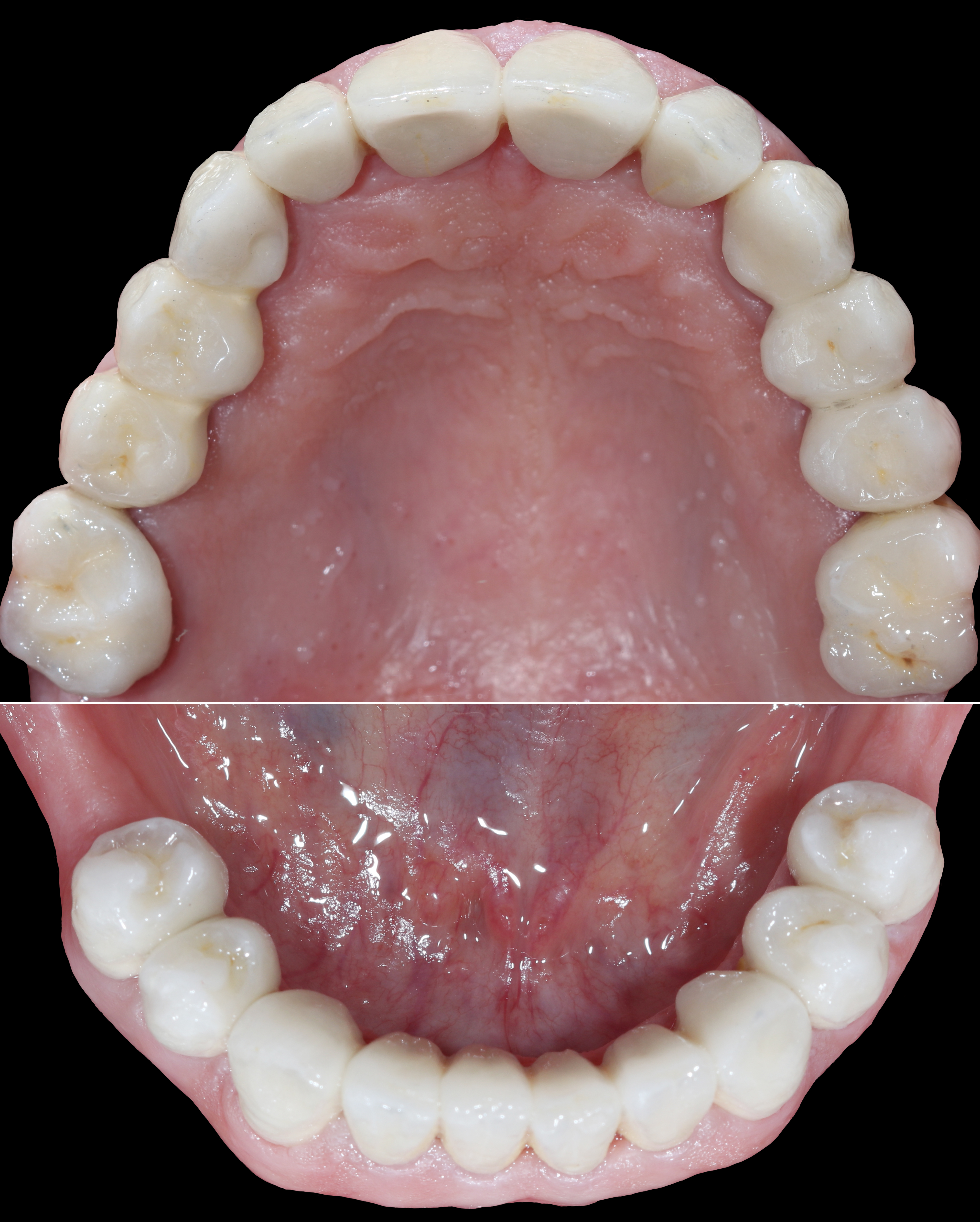 Τελική κατάσταση - Μασητική άποψη άνω και κάτω γνάθων