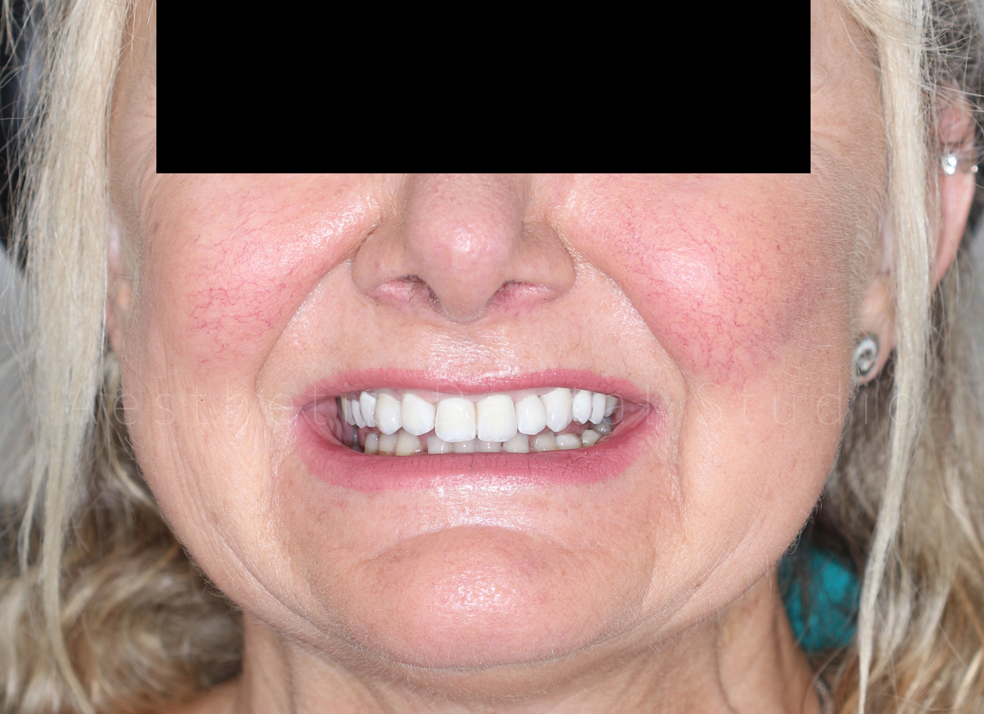 Από τον ψηφιακό σχεδιασμό στο τελικό αποτέλεσμα – 3ο στάδιο – Τελικό χαμόγελο, μετά από προσαρμογές σύμφωνα με τις αισθητικές προτιμήσεις της ασθενούς