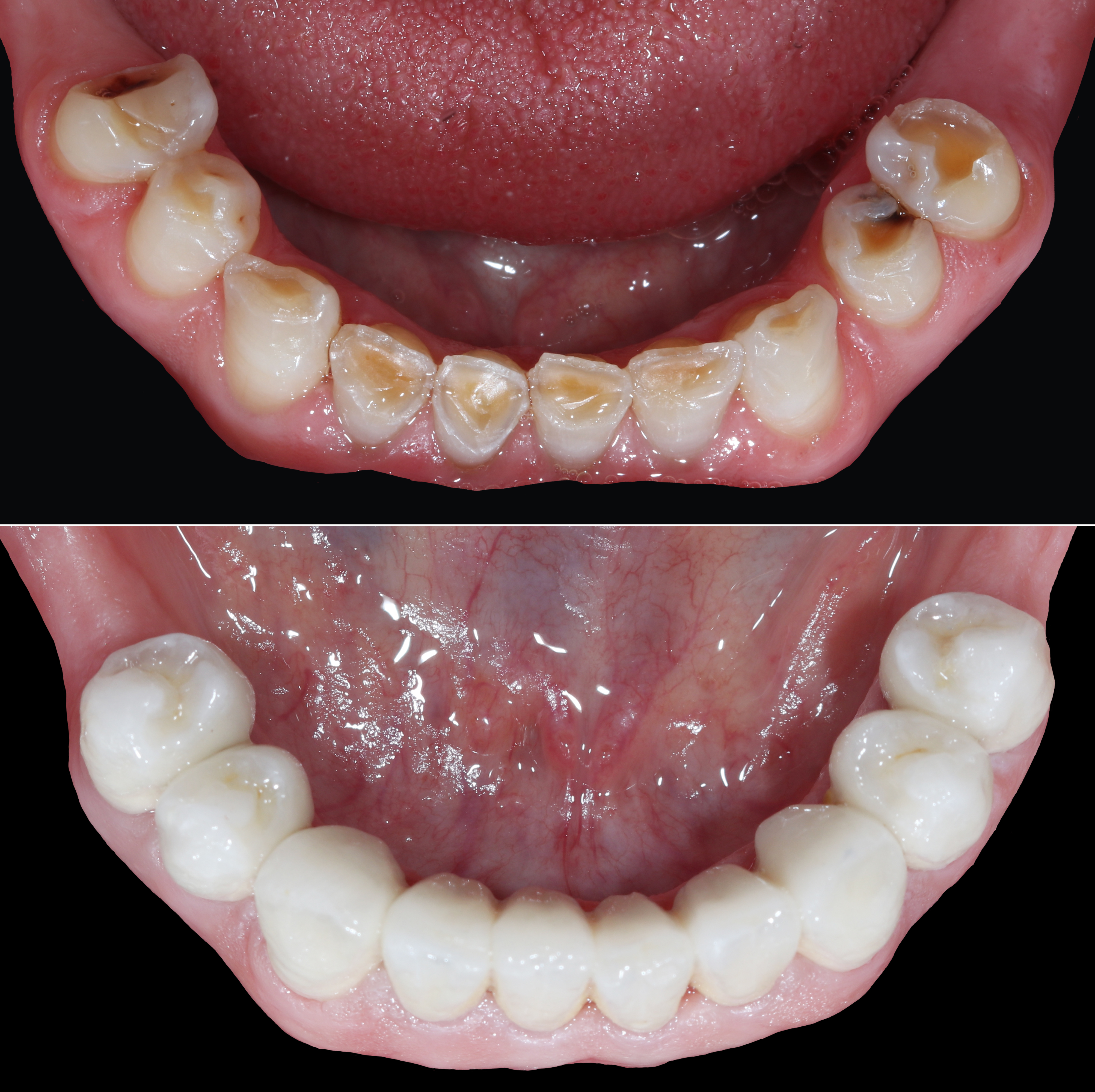 Σύγκριση αρχικής και τελικής κατάστασης – Μασητική άποψη της κάτω γνάθου πριν και μετά την αποκατάσταση


