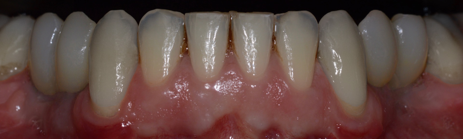 Τελική κατάστα�ση - Πρόσθια άποψη των αποκαταστάσεων της κάτω γνάθου, τοποθετημένες στο στόμα.