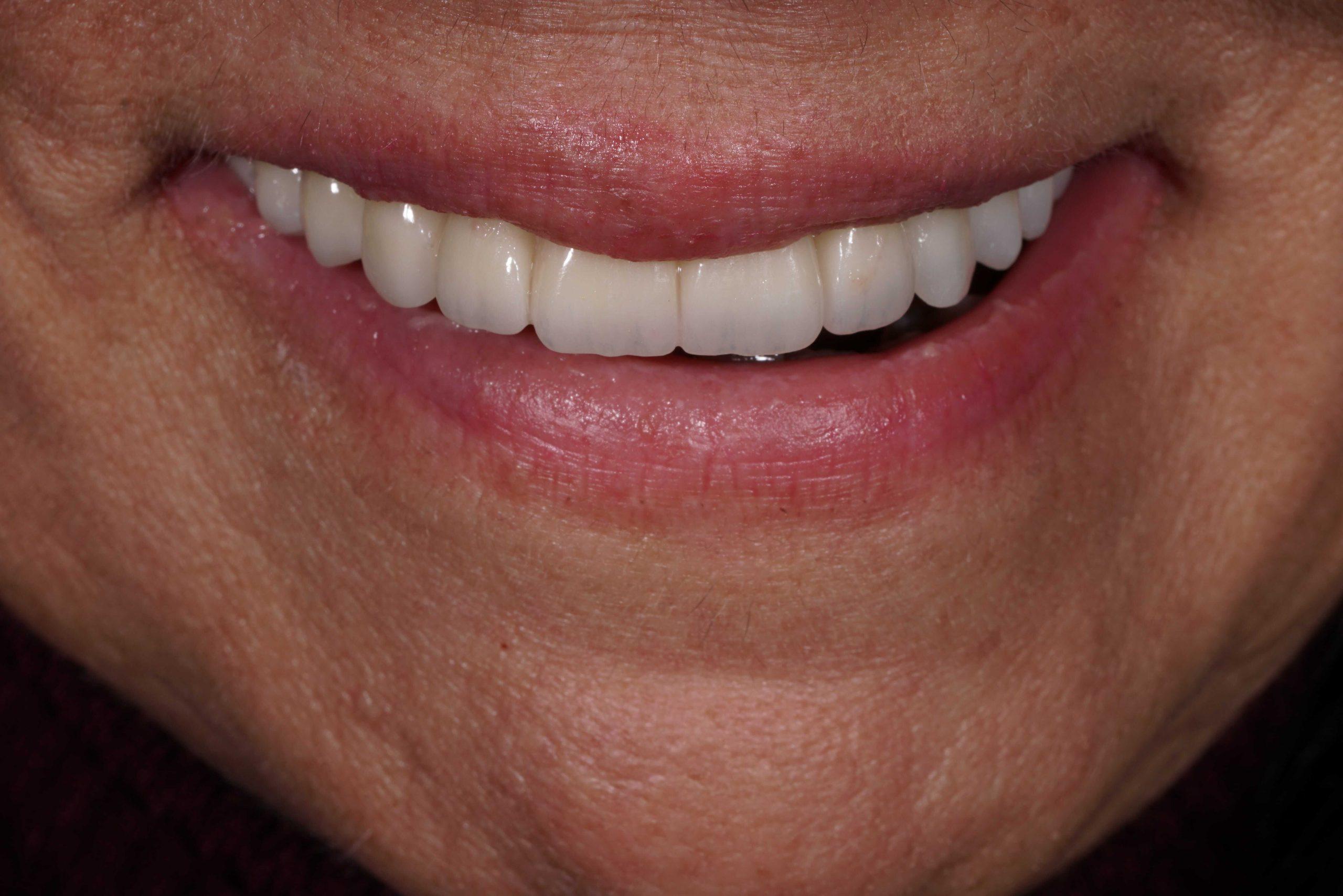 Το Digital Smile Design βοηθά στη δημιουργία φυσικών, αρμονικών και εξατομικευμένων χαμόγελων με σύγχρονες αισθητικές και προσθετικές τεχνικές.
