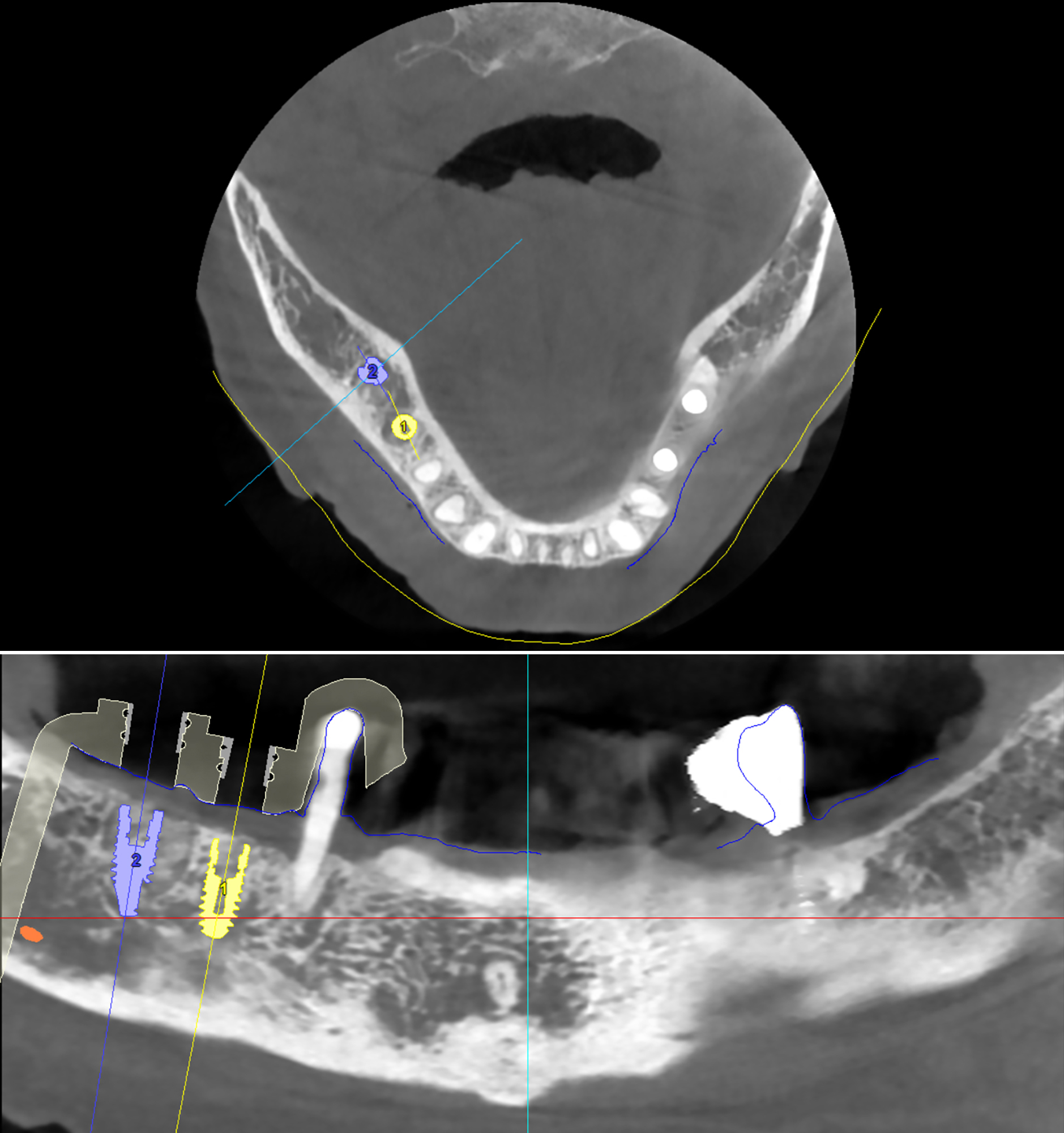 3D αξονική τομογραφία – Πανοραμική και εγκάρσια τομή της κάτω γνάθου της ασθενούς - Η τοποθέτηση των δύο εμφυτευμάτων έγινε στις ιδανικότερες θέσεις, με τη βοήθεια εξειδικευμένου λογισμικού χειρουργικού σχεδιασμού που χρησιμοποιούμε για την ακρίβεια και την ασφάλεια κάθε εμφυτευματικού περιστατ ικού