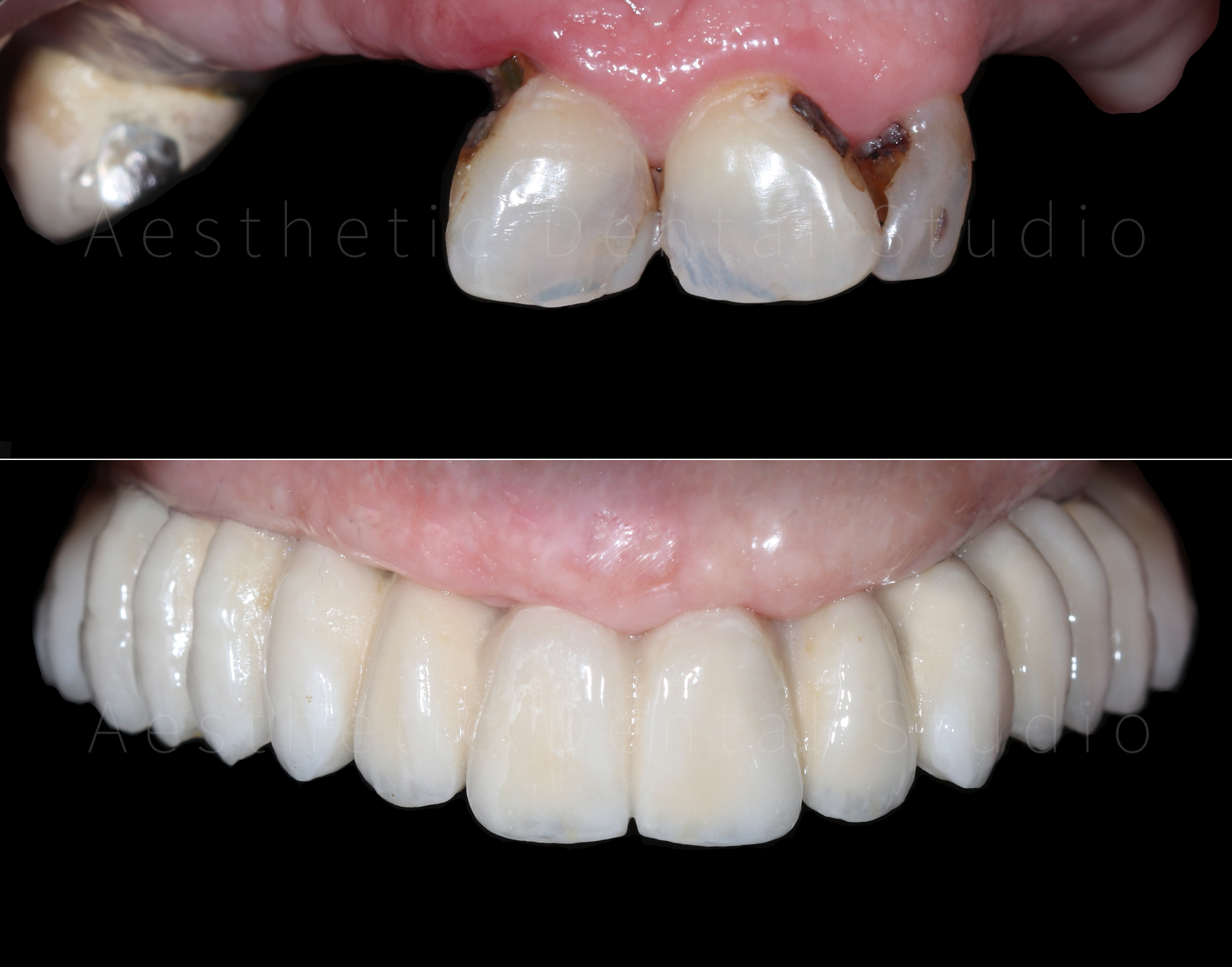 Άνω γνάθος — από εκτεταμένη φθορά και τερηδόνες σε πλήρη αποκατάσταση με κεραμική γέφυρα επί εμφυτευμάτων και φυσικό αισθητικό αποτέλεσμα