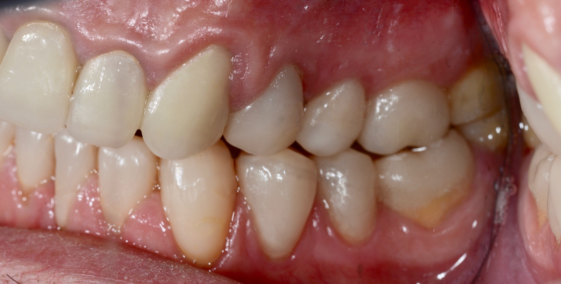 Τελική κατάσταση - Αριστερά άποψη