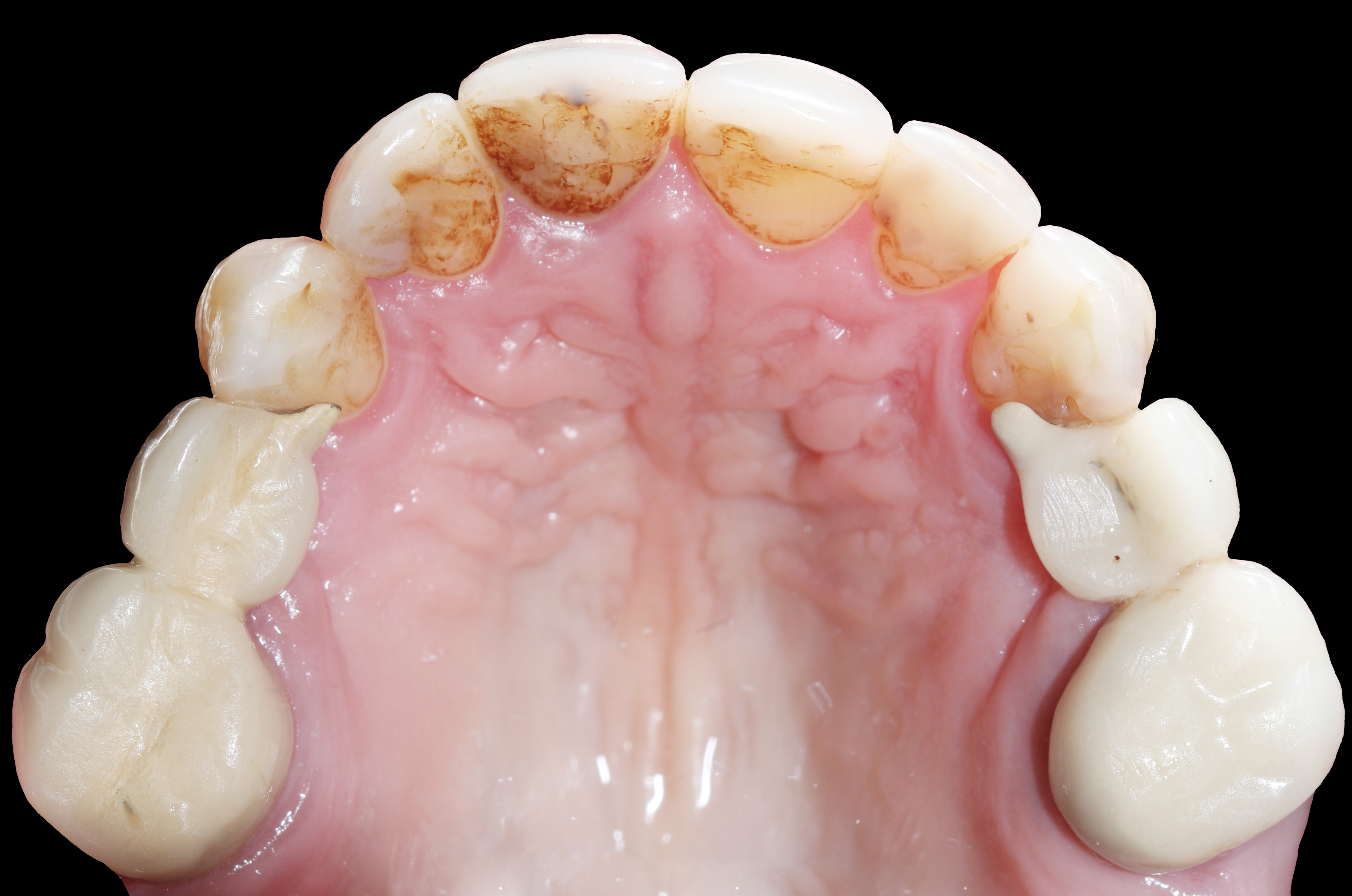 Άνω γνάθος - Μασητική άποψη πριν την αισθητική αποκατάσταση