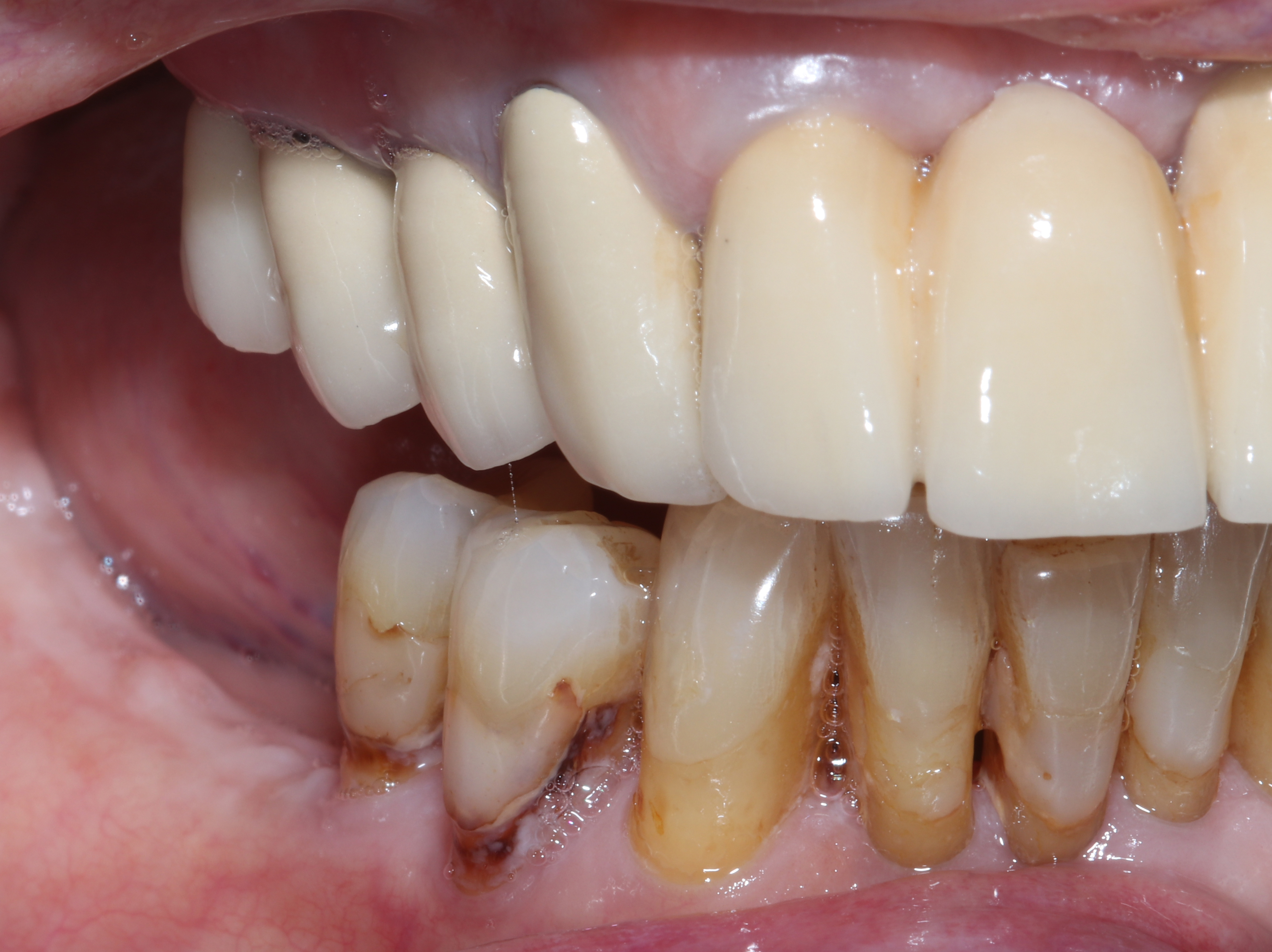 Αρχική κατάσταση - Πλάγια άποψη