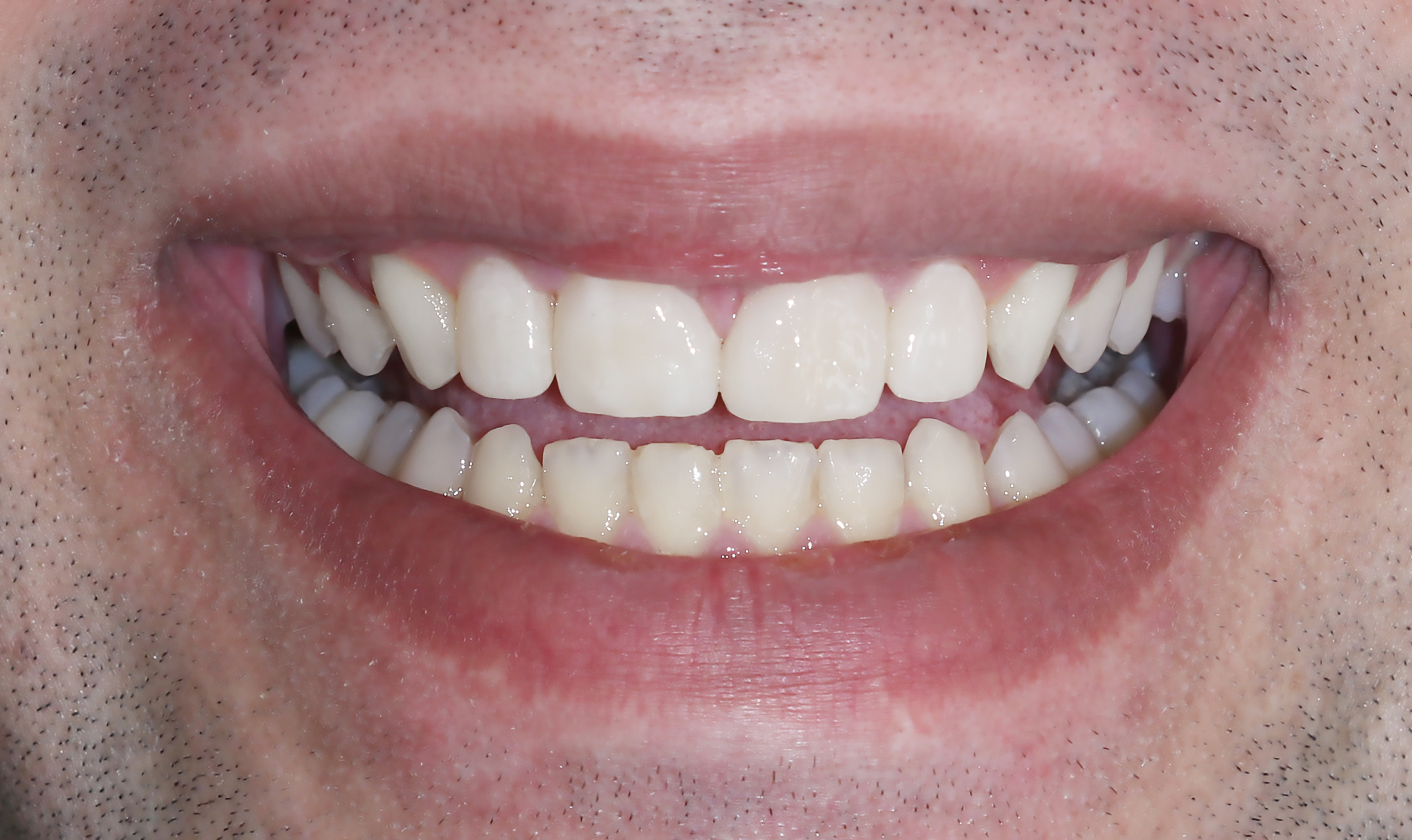 Τελική κατάσταση - Χαμόγελο