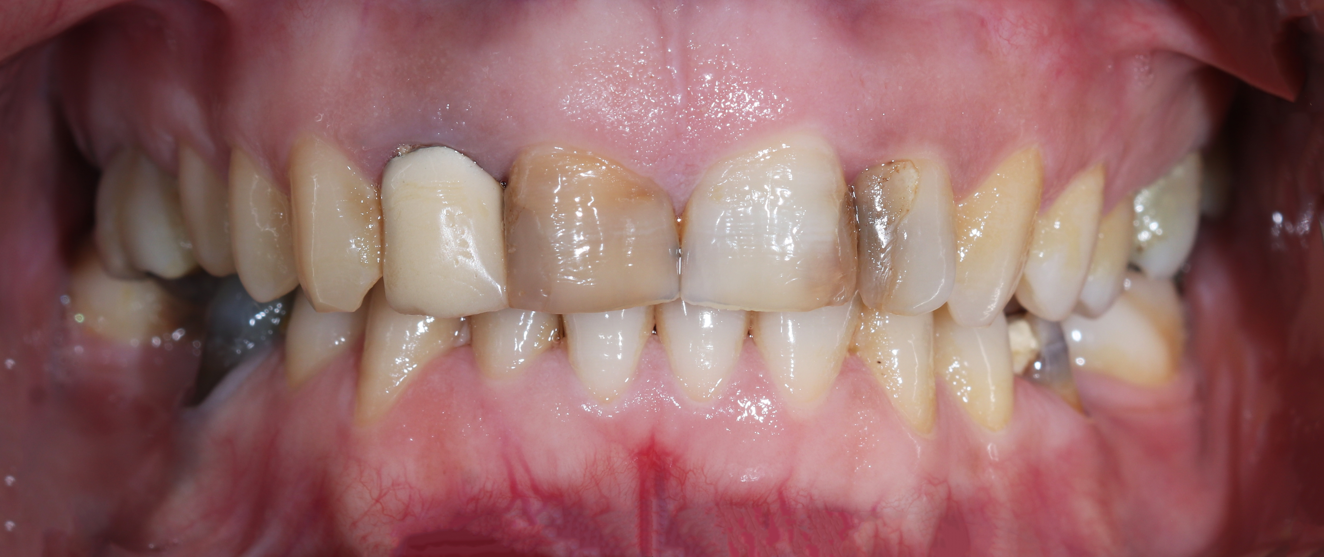 Αρχική κατάσταση - Πρόσθια άποψη με τα δόντια σε σύγκλειση