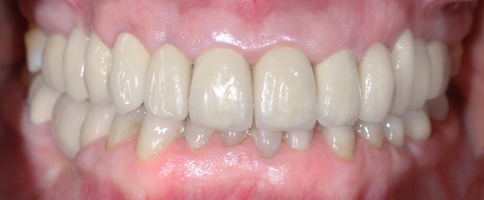Τελική κατάσταση - Πρόσθια άποψη των αποκαταστάσεων τοποθετημένων στο στόμα (σε σύγκλειση) - Αποκατάσταση της αισθητικής και της σύγκλεισης της ασθενούς