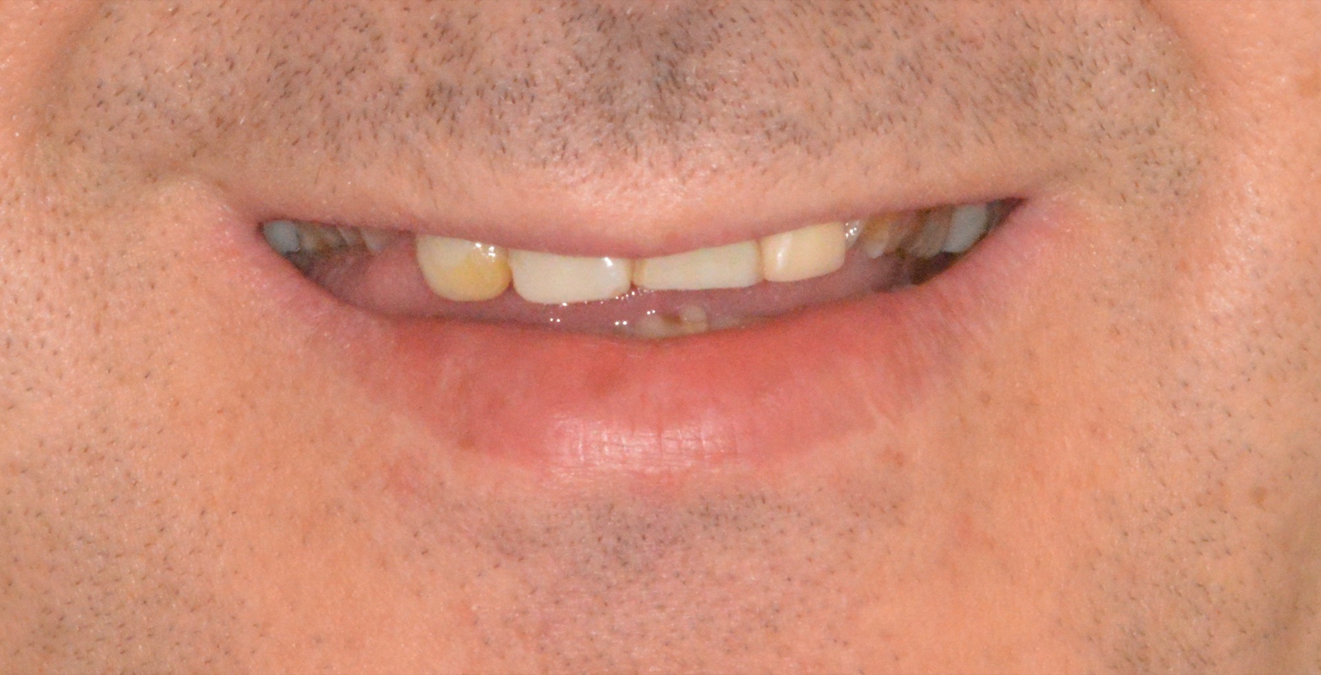 Αρχική κατάσταση - Χαμόγελο.