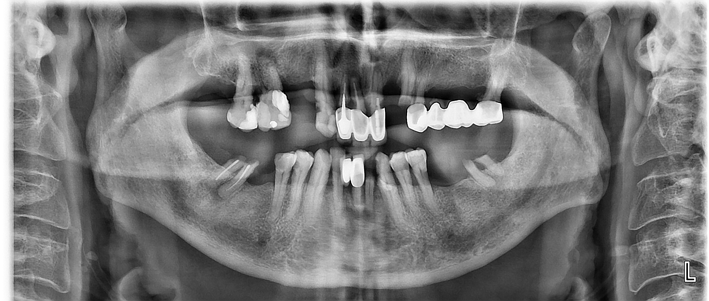 Πανοραμική ακτινογραφία με την αρχική κατάσταση της ασθενούς - Ενεργή περιοδοντική νόσος, τερηδονισμένα δόντια και κακότεχνες προσθετικές εργασίες