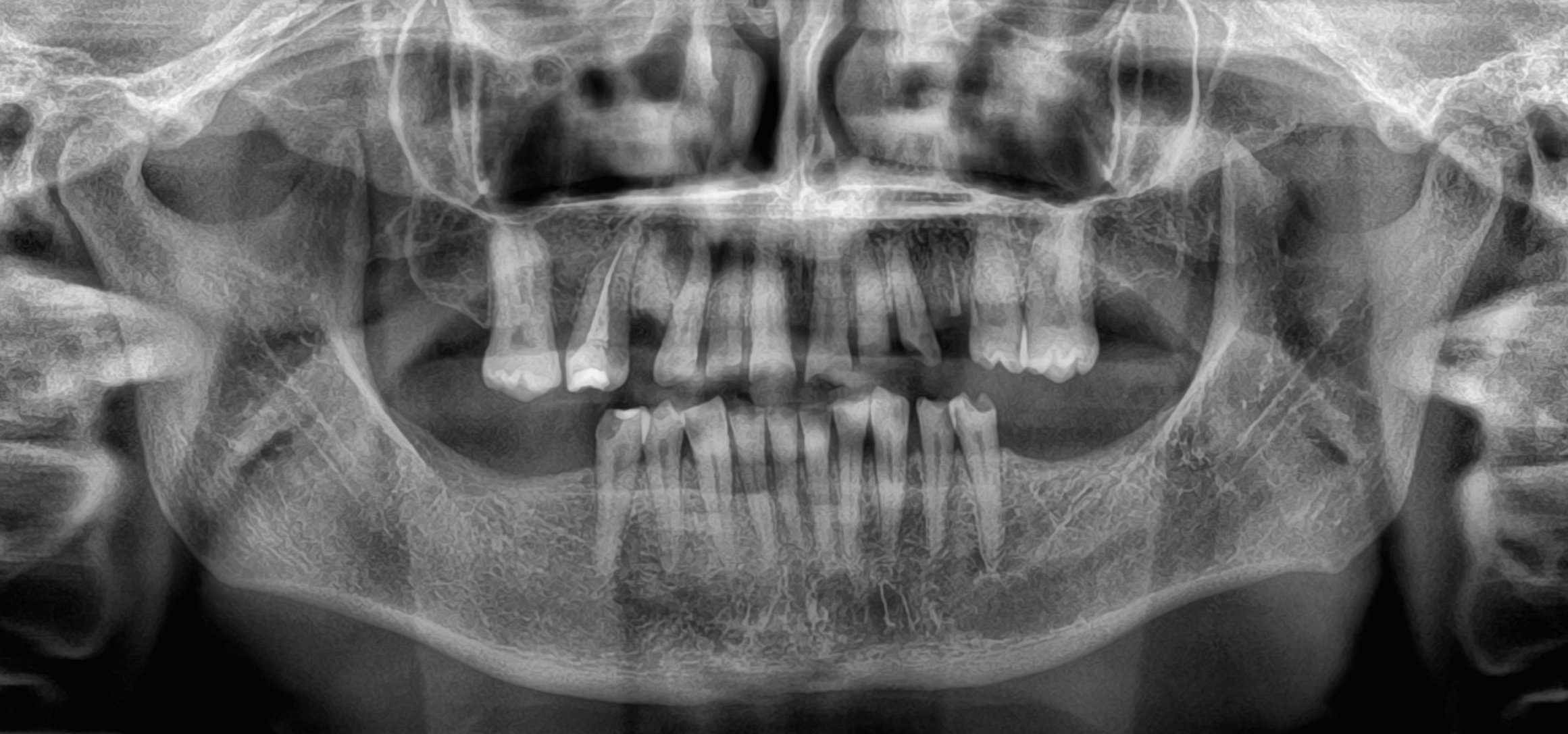 Αρχική κατάσταση - Πανοραμική ακτινογραφία -  Κατεστραμμένα δόντια δεξιά και αριστερά στην άνω γνάθο, τερηδόνες και οδοντική φθορά