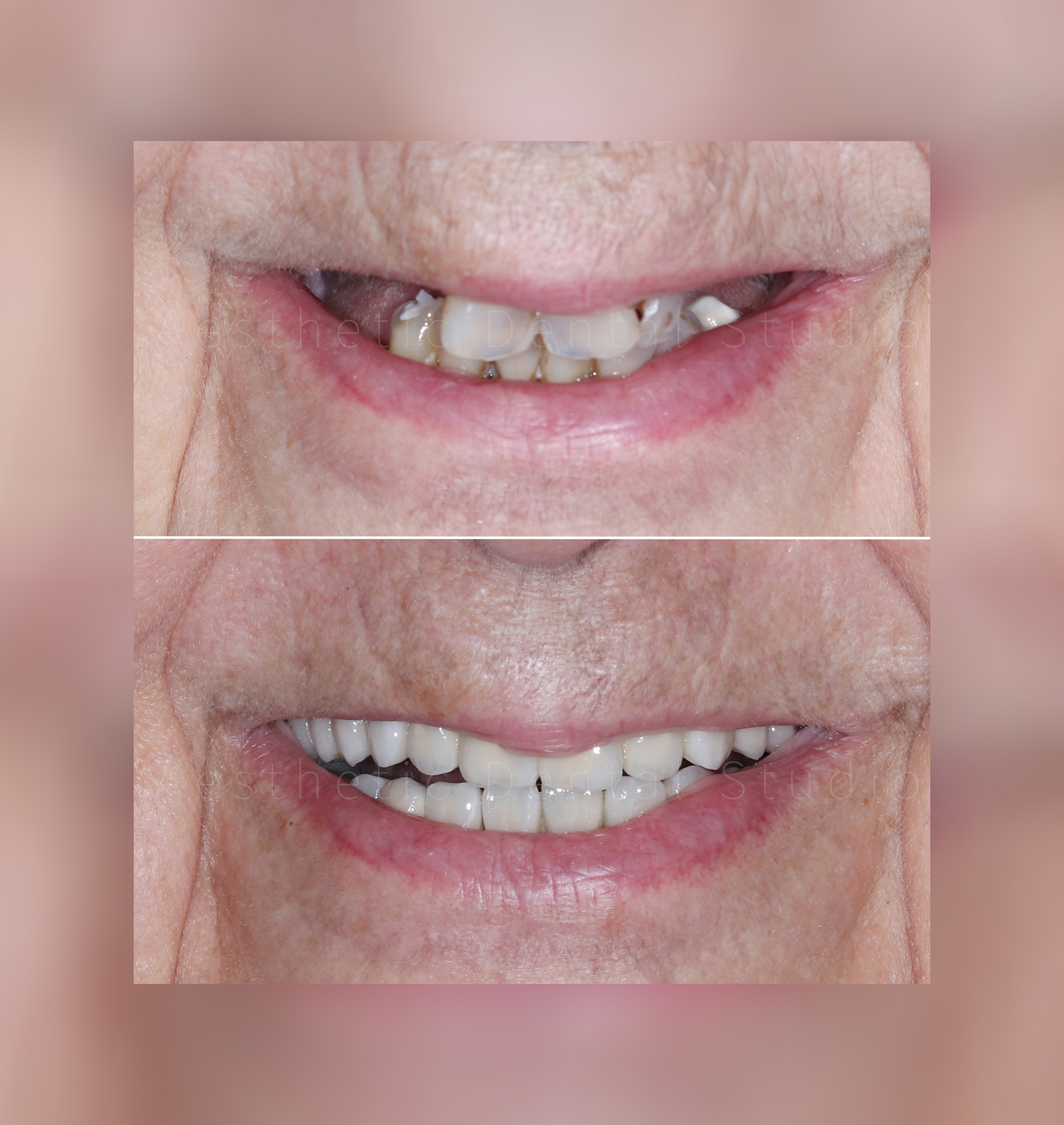 Αισθητική βελτίωση με εμφυτεύματα – Από το πριν στο μετά