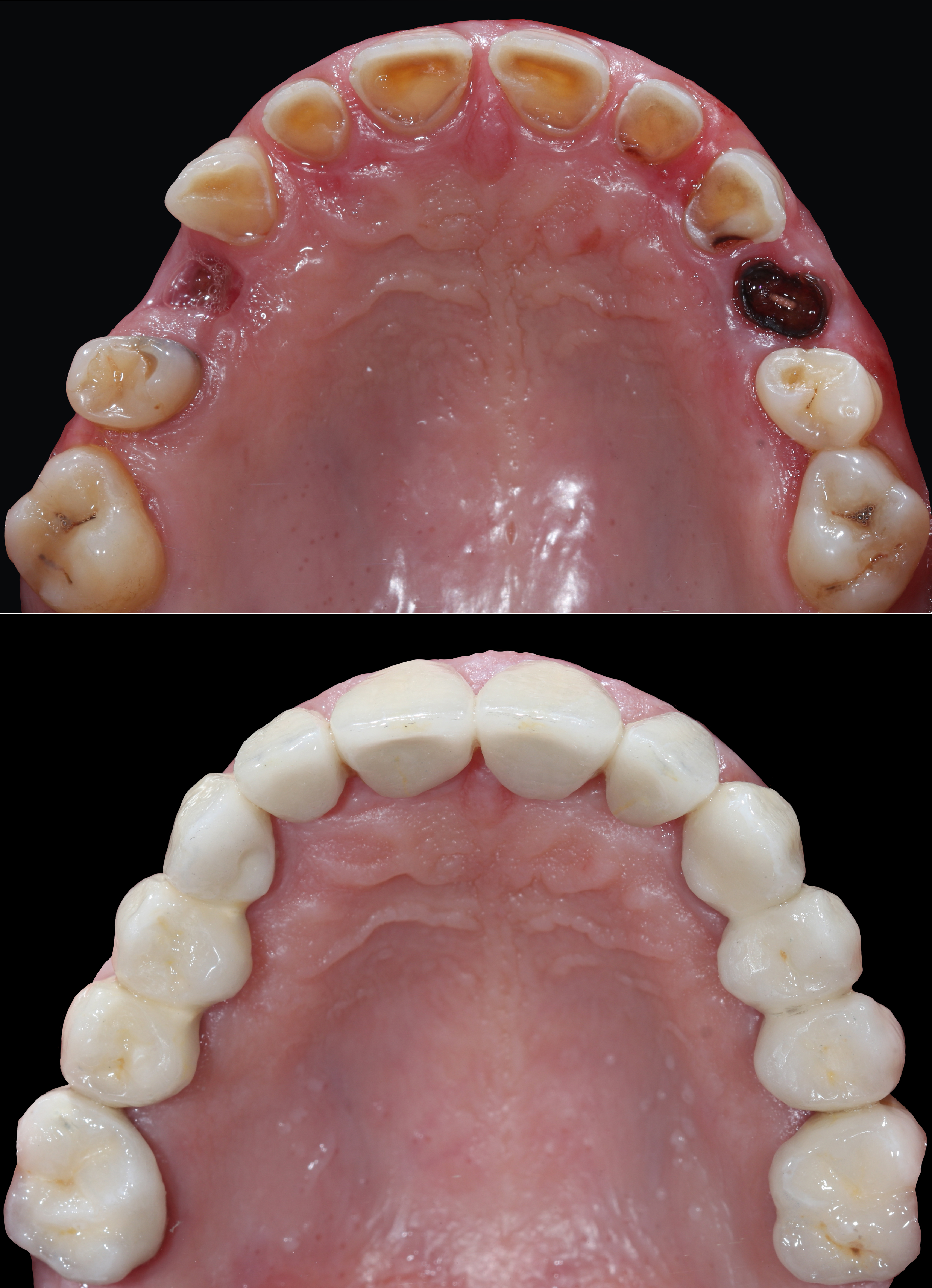 Σύγκριση αρχικής και τελικής κατάστασης – Μασητική άποψη της άνω γνάθου πριν και μετά την αποκατάσταση