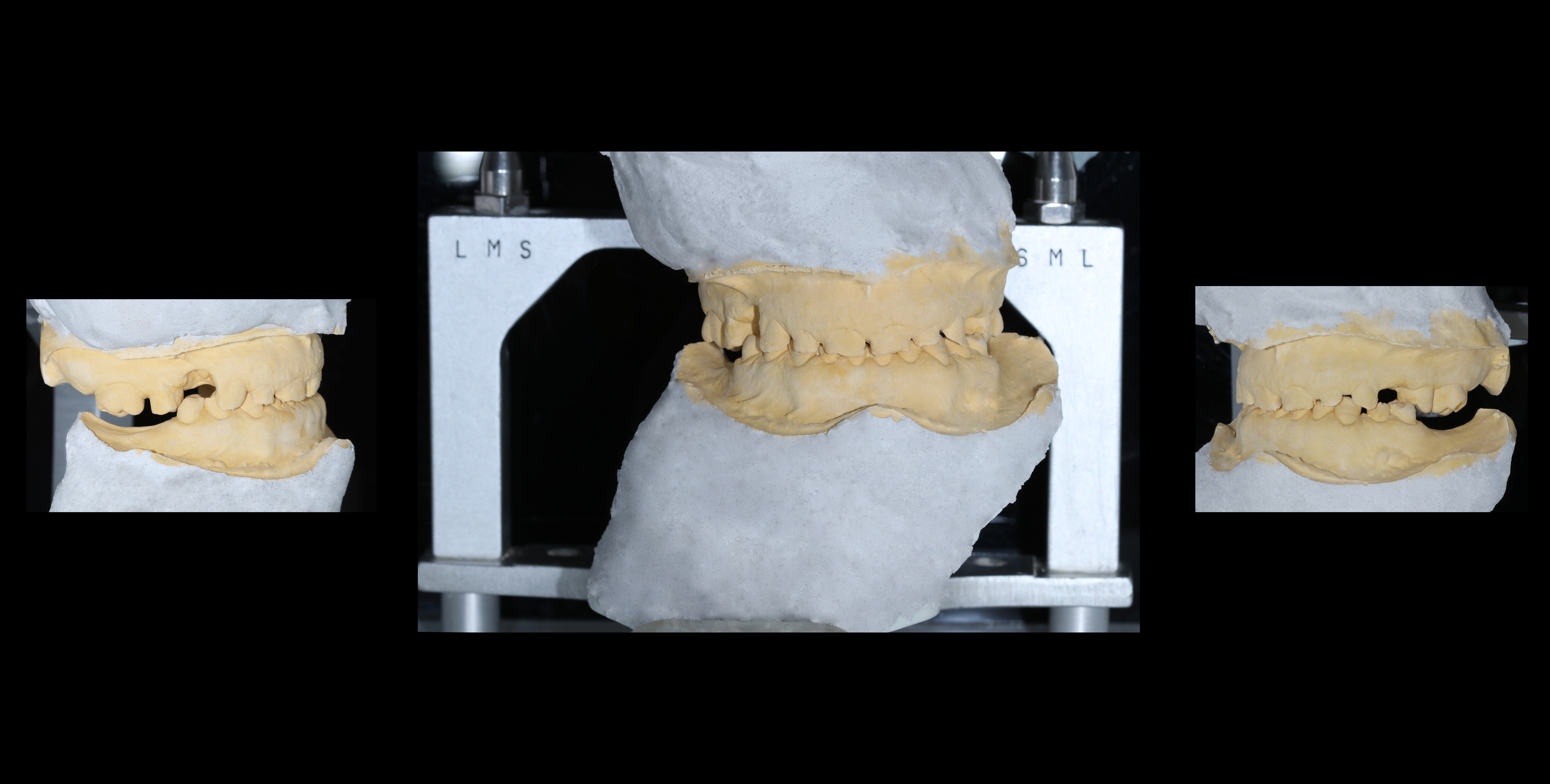 Αρχική κατάσταση - Αναρτημένα εκμαγεία της άνω και κάτω γνάθου σε γναθολογικό εργαλείο (αρθρωτήρας) για μελέτη της σύγκλεισης των δοντιών, των έκκεντρων κινήσεων της κάτω γνάθου και των διαθέσιμων χώρων μεταξύ των δύο οδοντικών φραγμών
