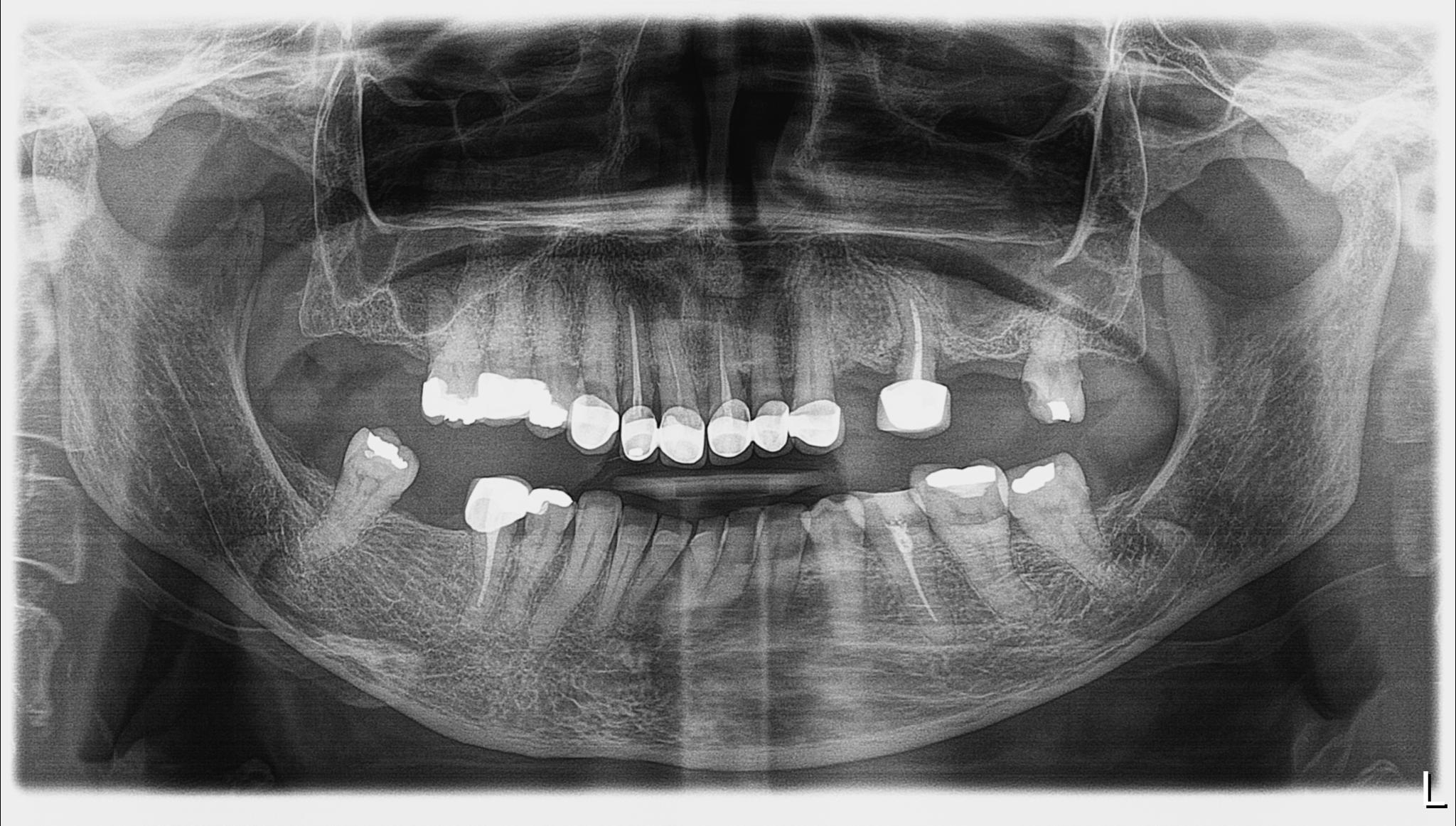 Πανοραμική ακτινογραφία με την αρχική κατάσταση της ασθενούς - Ενεργή περιοδοντική νόσος, τερηδονισμένα δόντια και κακότεχνες προσθετικές εργασίες